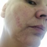 Kontaktallergien, Epicutan-Test und warum ich mir jetzt Pulver in die Haare schmiere 6 epicutan test kochtrotz kontaktallergie 1 2kochtrotzt-rezepte