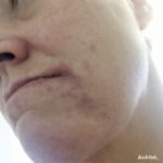 Kontaktallergien, Epicutan-Test und warum ich mir jetzt Pulver in die Haare schmiere 5 epicutan test kochtrotz kontaktallergie 1 3kochtrotzt-rezepte